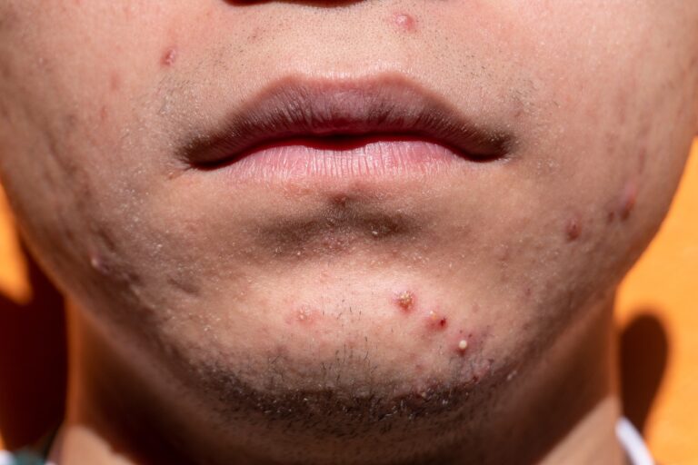 Silice contre l’acné — Conseils d’utilisation